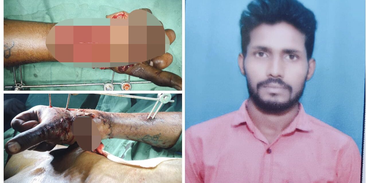 ಯಂತ್ರದಲ್ಲಿ ಸಿಲುಕಿದ ಕೈ ; ಸಹಾಯದ ನಿರೀಕ್ಷೆಯಲ್ಲಿ ಬಡ ‌ಕುಟುಂಬ