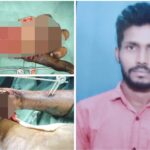 ಯಂತ್ರದಲ್ಲಿ ಸಿಲುಕಿದ ಕೈ ; ಸಹಾಯದ ನಿರೀಕ್ಷೆಯಲ್ಲಿ ಬಡ ‌ಕುಟುಂಬ