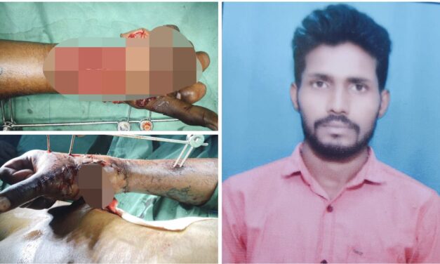 ಯಂತ್ರದಲ್ಲಿ ಸಿಲುಕಿದ ಕೈ ; ಸಹಾಯದ ನಿರೀಕ್ಷೆಯಲ್ಲಿ ಬಡ ‌ಕುಟುಂಬ
